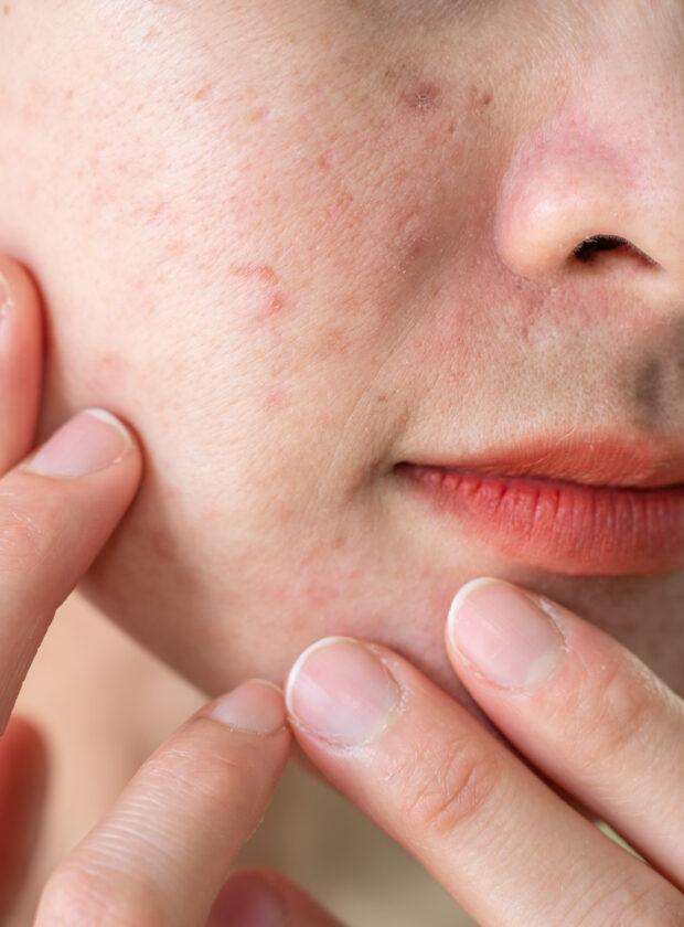 quando usar a espironolactona para acne 01