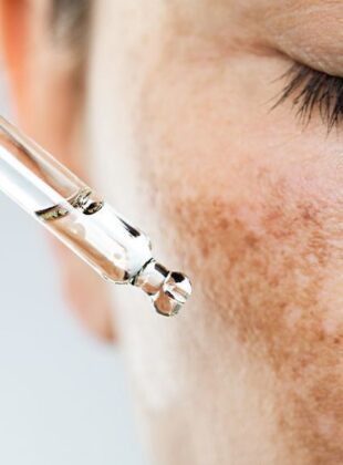 clareadores de melasma