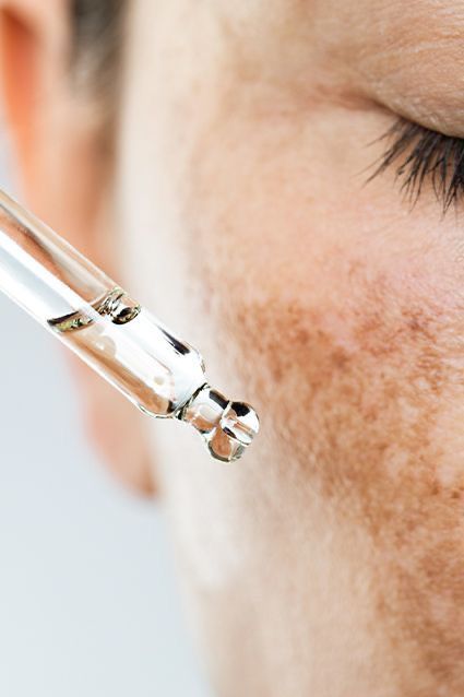 clareadores de melasma