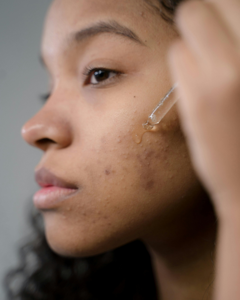 tirar manchas de espinhas