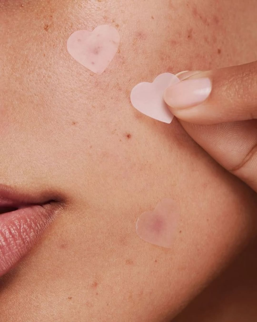 tirar manchas de espinhas