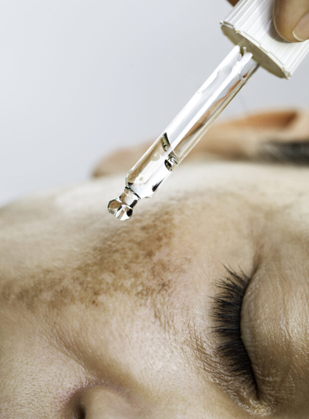 melasma